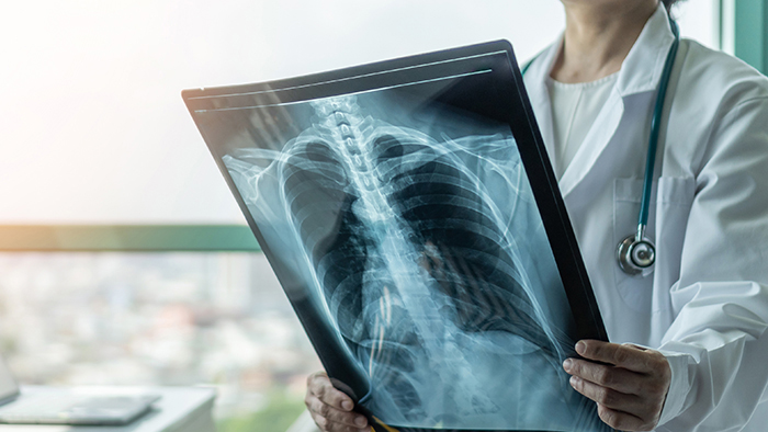 Doctor holding an x-ray film