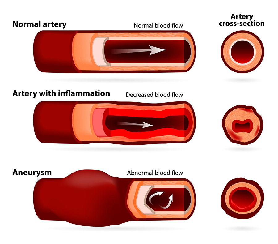 example of artery wall