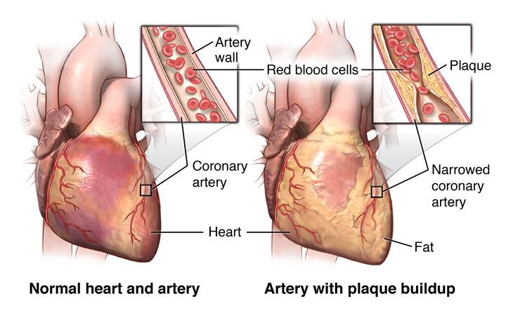 Diseased heart diagram
