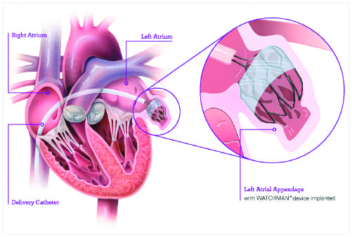 WATCHMAN Implant diagram