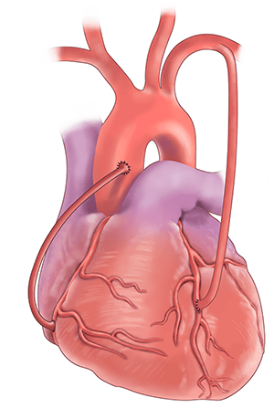 coronary artery bypass surgery diagram