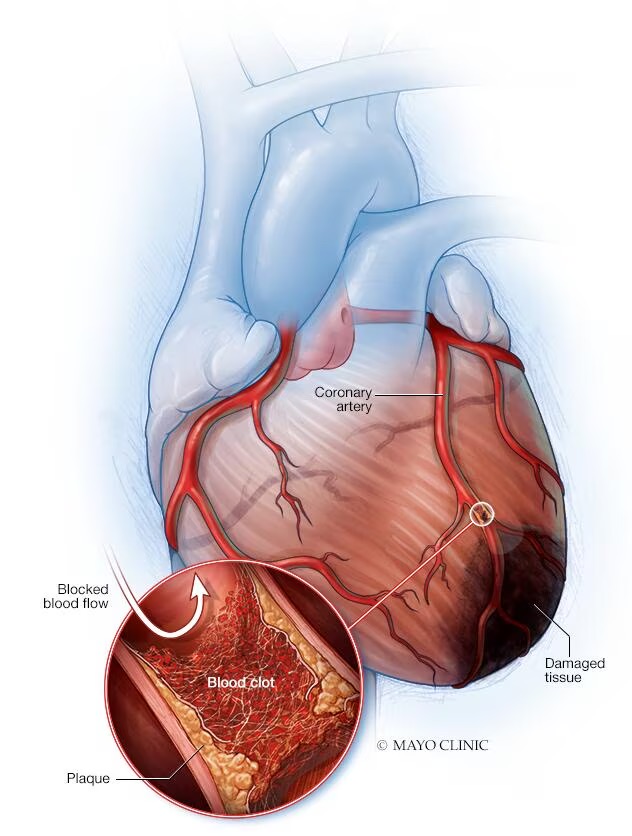 heart attack damaged heart