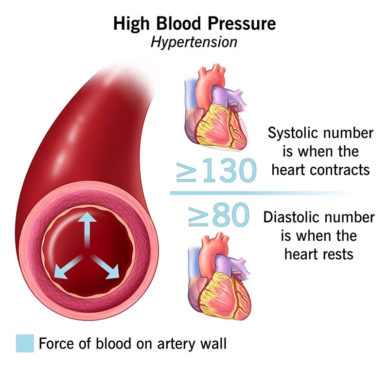 high blood pressure illustration