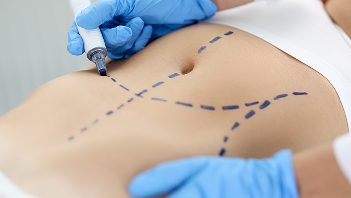 doctor marking on patients stomach