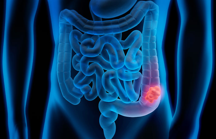 screening for colon cancer