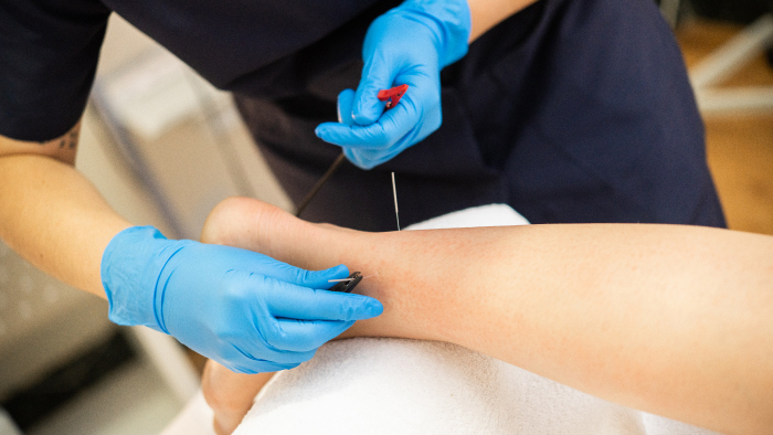 Female therapists performing dry needling on patient's leg