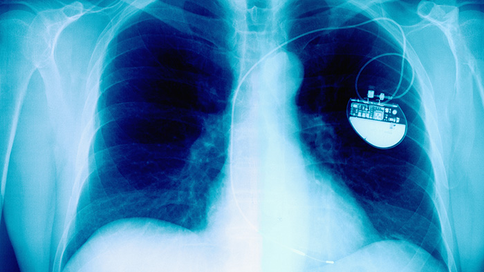 x-ray of chest with pacemaker