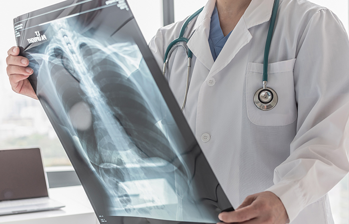 A doctor holds up an xray showing a mass in the chest