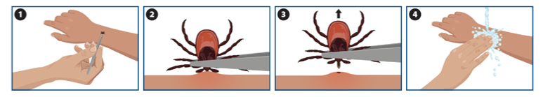 chart of how to remove a tick
